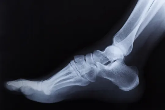 Переломы лодыжек